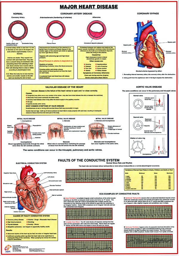 Major Heart Disease - A1 Chart